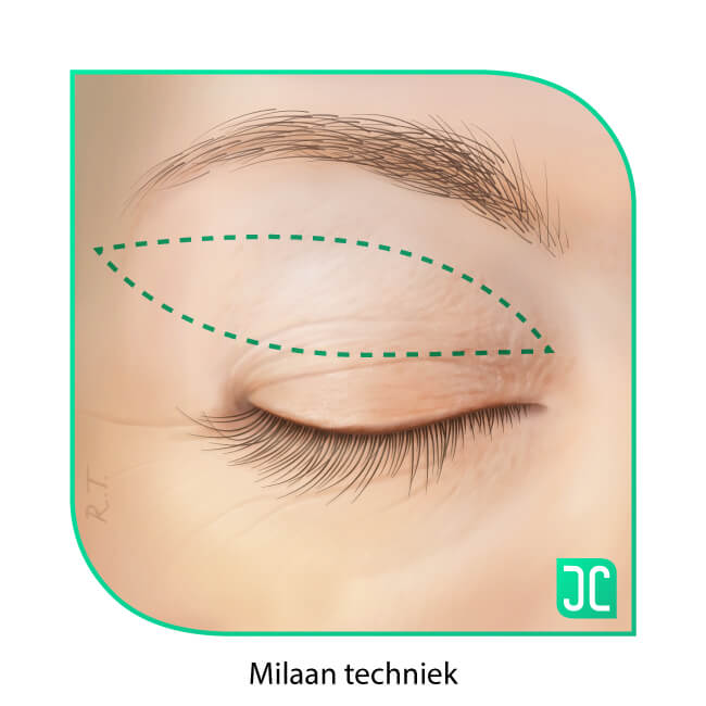 ooglidcorrectie milaan techniek incisie