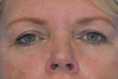 ooglidcorrectie voor vrouw 1